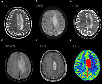 Multiparametric MR Imaging Features of Primary CNS Lymphomas